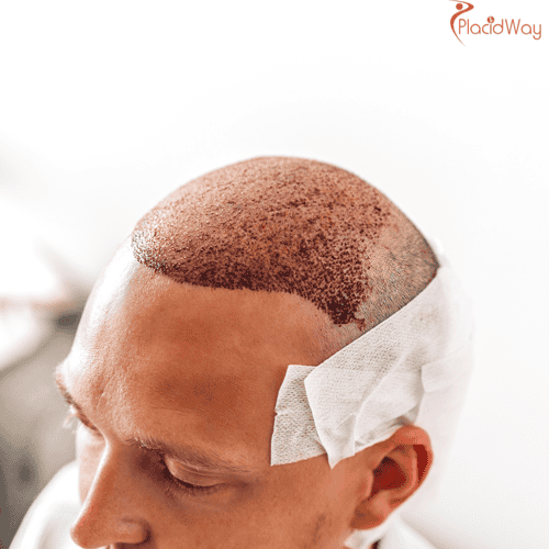 Why Should You Choose Hair Transplant in India?